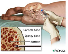 Bone Marrow Aspiration