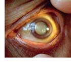 cataract_close.jpg