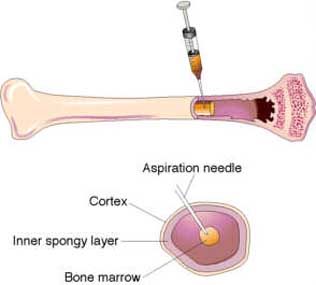 BoneMarrowAsp.jpg